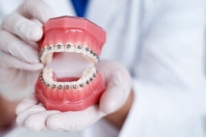 the doctor shows how the system of braces on teeth is arranged